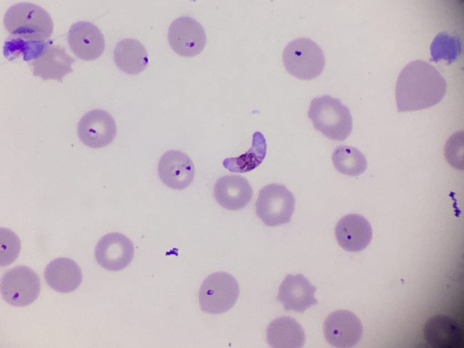 malaria